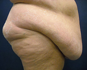 Chicago Abdominoplasty, Chicago tummy tuck, abdominoplasty photo, tummy tuck photo, tummy tuck picture, tummy tuck photograph, abdominoplasty picture, Chicago Tummy Tuck Photo, Chicago Tummy Tuck Picture, Chicago panniculectomy, panniculectomy
